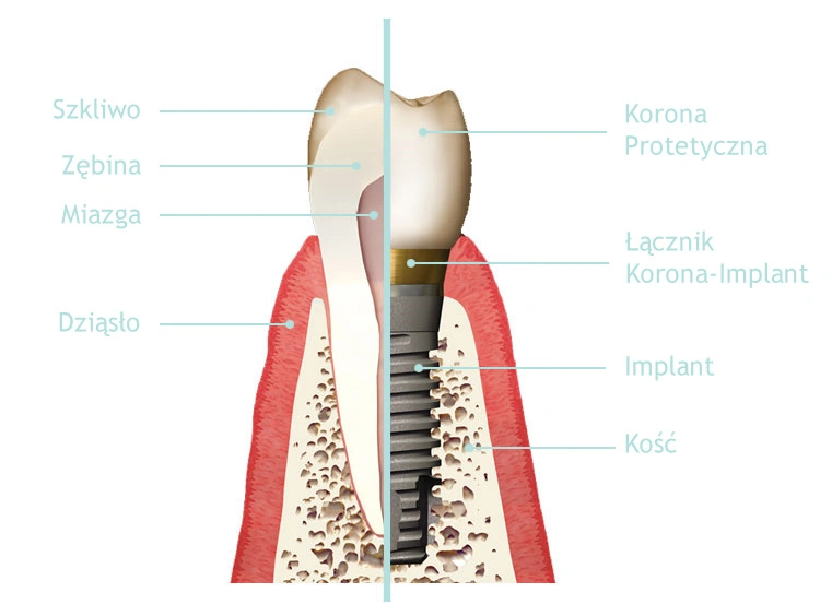 rysunek implanta zębowego