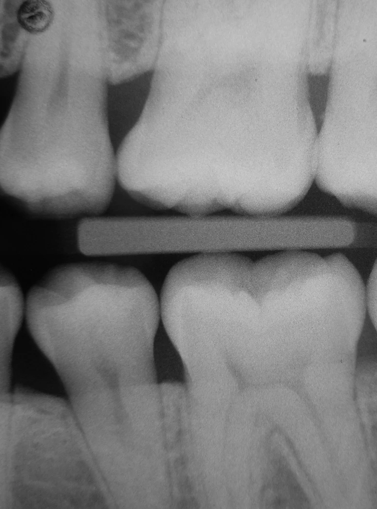 zdjęcie rtg punktowe zębów