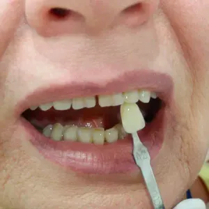 pacjent-1-stomatologia-estetyczna-1