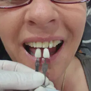 pacjent-2-stomatologia-estetyczna-1