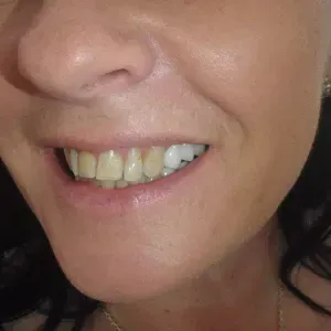 pacjent-2-stomatologia-estetyczna-2