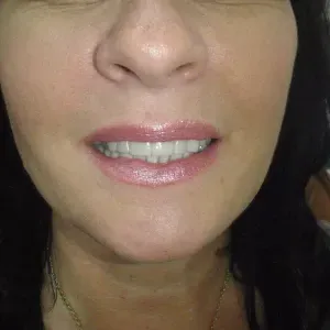 pacjent-2-stomatologia-estetyczna-4